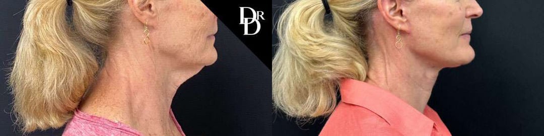 Facelift Before And After Photos By Dr. Demetri Arnaoutakis In Tampa, Fl