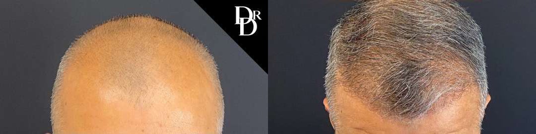 Hair Transplant Before And After Photos By Dr. Demetri Arnaoutakis In Tampa, Fl