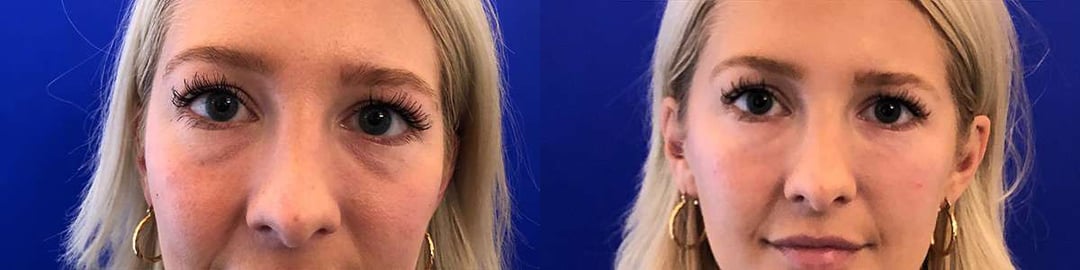 Injectable/Dermal Fillers Before And After Photos By Dr. Demetri Arnaoutakis In Tampa, Fl