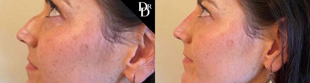 Liquid Rhinoplasty Before And After Photos By Dr. Demetri Arnaoutakis In Tampa, Fl