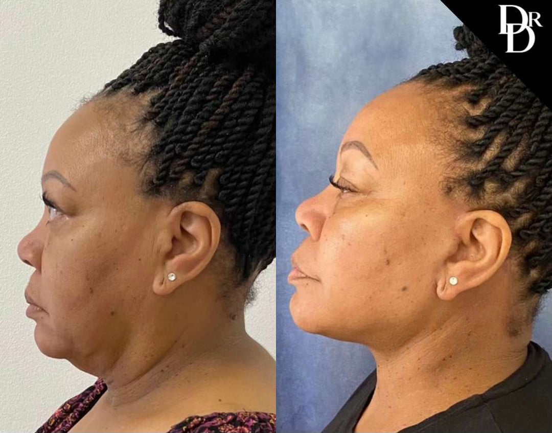 Neck Lift Before And After Photos By Dr. Demetri Arnaoutakis In Tampa, Fl