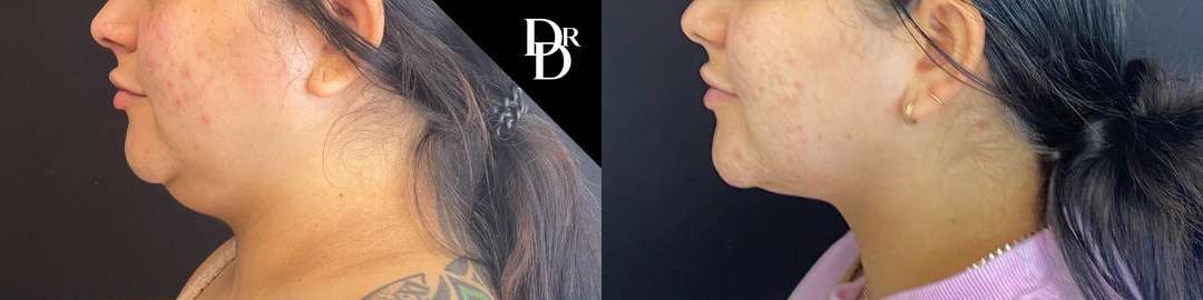 Facetite Before And After Photos By Dr. Demetri Arnaoutakis In Tampa, Fl
