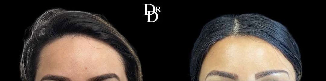 Hairline Lowering Surgery Before And After Photos By Dr. Demetri Arnaoutakis In Tampa, Fl