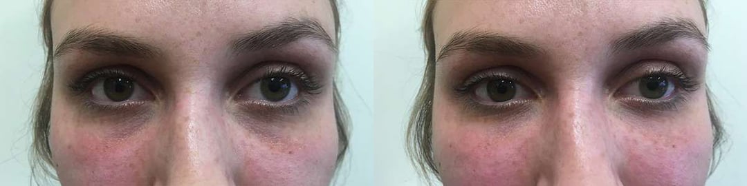 Injectable/Dermal Fillers Before And After Photos By Dr. Demetri Arnaoutakis In Tampa, Fl