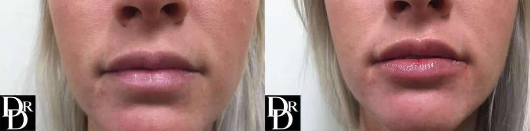 Injectable/Dermal Fillers Before And After Photos By Dr. Demetri Arnaoutakis In Tampa, Fl