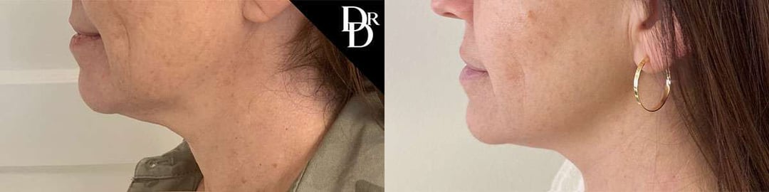 Morpheus8 Before And After Photos By Dr. Demetri Arnaoutakis In Tampa, Fl