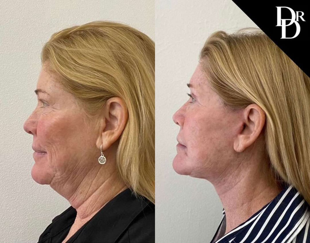 Neck Lift Before And After Photos By Dr. Demetri Arnaoutakis In Tampa, Fl