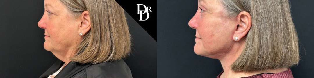 Facelift Before And After Photos By Dr. Demetri Arnaoutakis In Tampa, Fl
