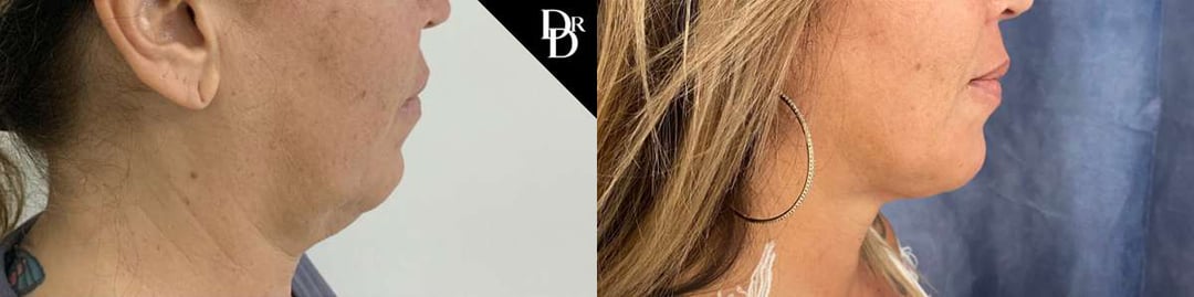Facetite Before And After Photos By Dr. Demetri Arnaoutakis In Tampa, Fl