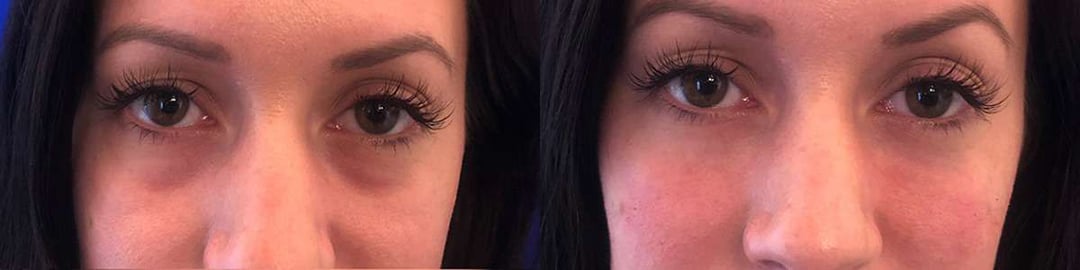 Injectable/Dermal Fillers Before And After Photos By Dr. Demetri Arnaoutakis In Tampa, Fl
