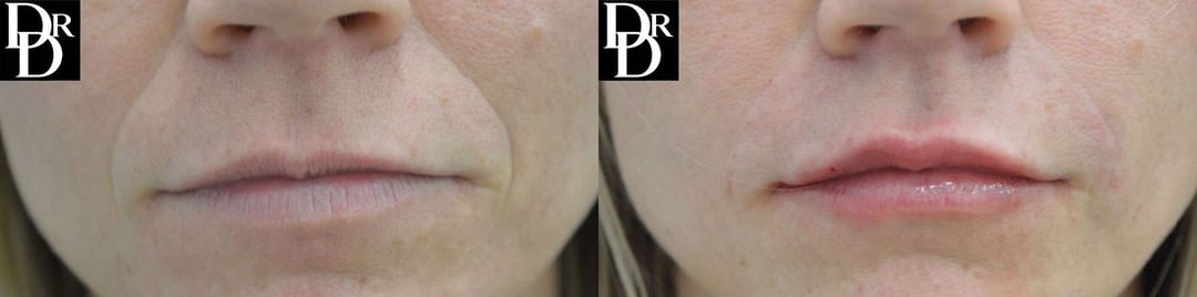 Injectable/Dermal Fillers Before And After Photos By Dr. Demetri Arnaoutakis In Tampa, Fl