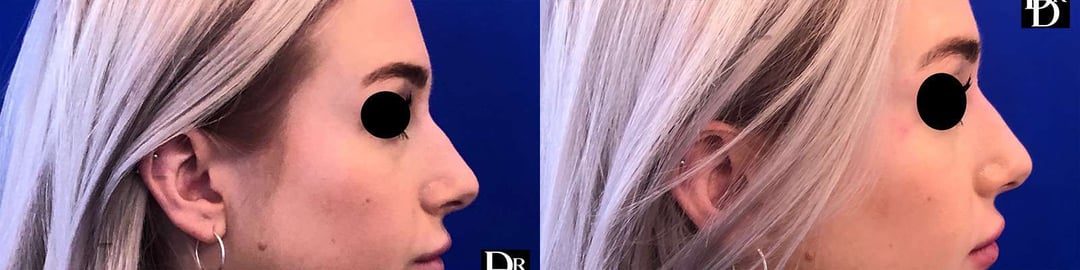 Liquid Rhinoplasty Before And After Photos By Dr. Demetri Arnaoutakis In Tampa, Fl