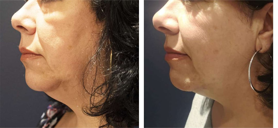 Morpheus8 Before And After Photos By Dr. Demetri Arnaoutakis In Tampa, Fl