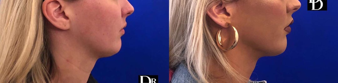 Neck Lift Before And After Photos By Dr. Demetri Arnaoutakis In Tampa, Fl