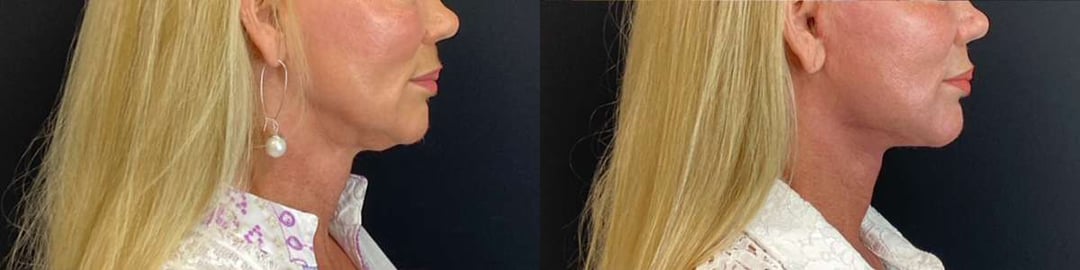 Facelift Before And After Photos By Dr. Demetri Arnaoutakis In Tampa, Fl