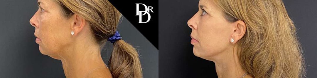 Facelift Before And After Photos By Dr. Demetri Arnaoutakis In Tampa, Fl
