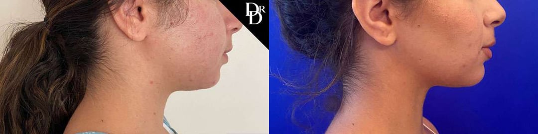 Buccal Fat Pad Removal Before And After Photos By Dr. Demetri Arnaoutakis In Tampa, Fl