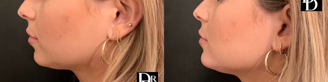 Chin Augmentation Before And After Photos By Dr. Demetri Arnaoutakis In Tampa, Fl