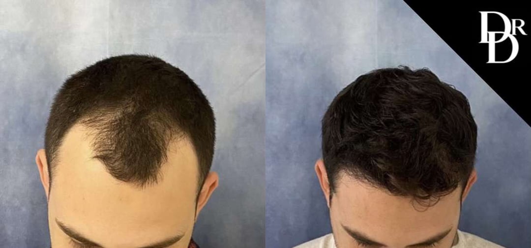 Hair Transplant Before And After Photos By Dr. Demetri Arnaoutakis In Tampa, Fl