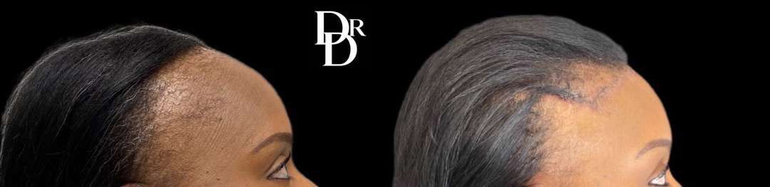 Hairline Lowering Surgery Before And After Photos By Dr. Demetri Arnaoutakis In Tampa, Fl