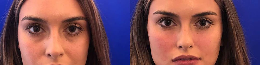 Injectable/Dermal Fillers Before And After Photos By Dr. Demetri Arnaoutakis In Tampa, Fl