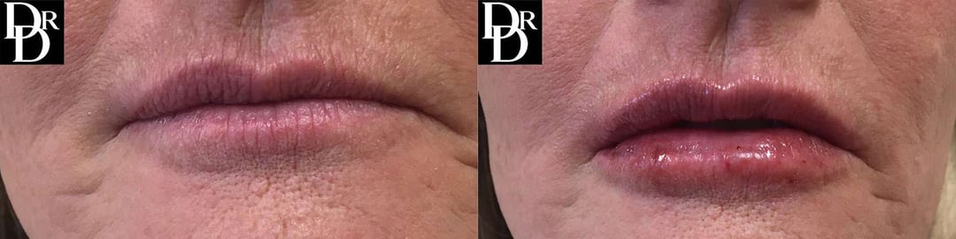 Injectable/Dermal Fillers Before And After Photos By Dr. Demetri Arnaoutakis In Tampa, Fl