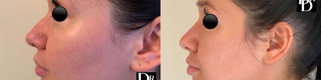 Liquid Rhinoplasty Before And After Photos By Dr. Demetri Arnaoutakis In Tampa, Fl