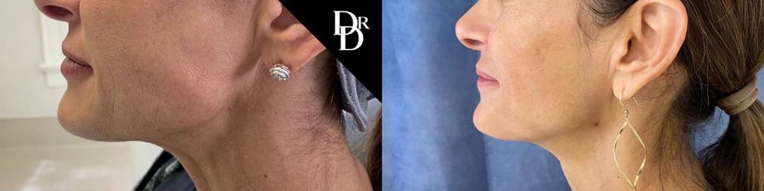 Morpheus8 Before And After Photos By Dr. Demetri Arnaoutakis In Tampa, Fl