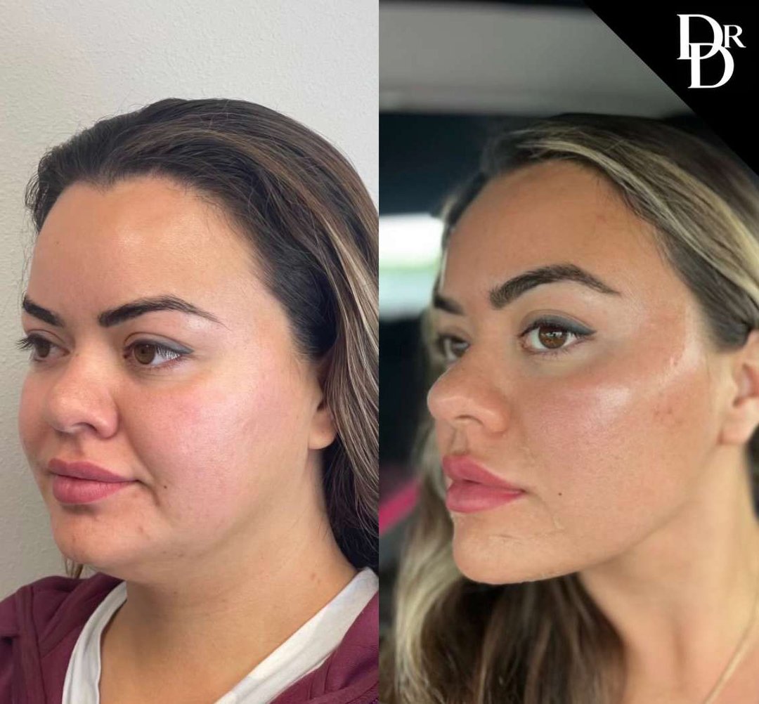 Neck Lift Before And After Photos By Dr. Demetri Arnaoutakis In Tampa, Fl