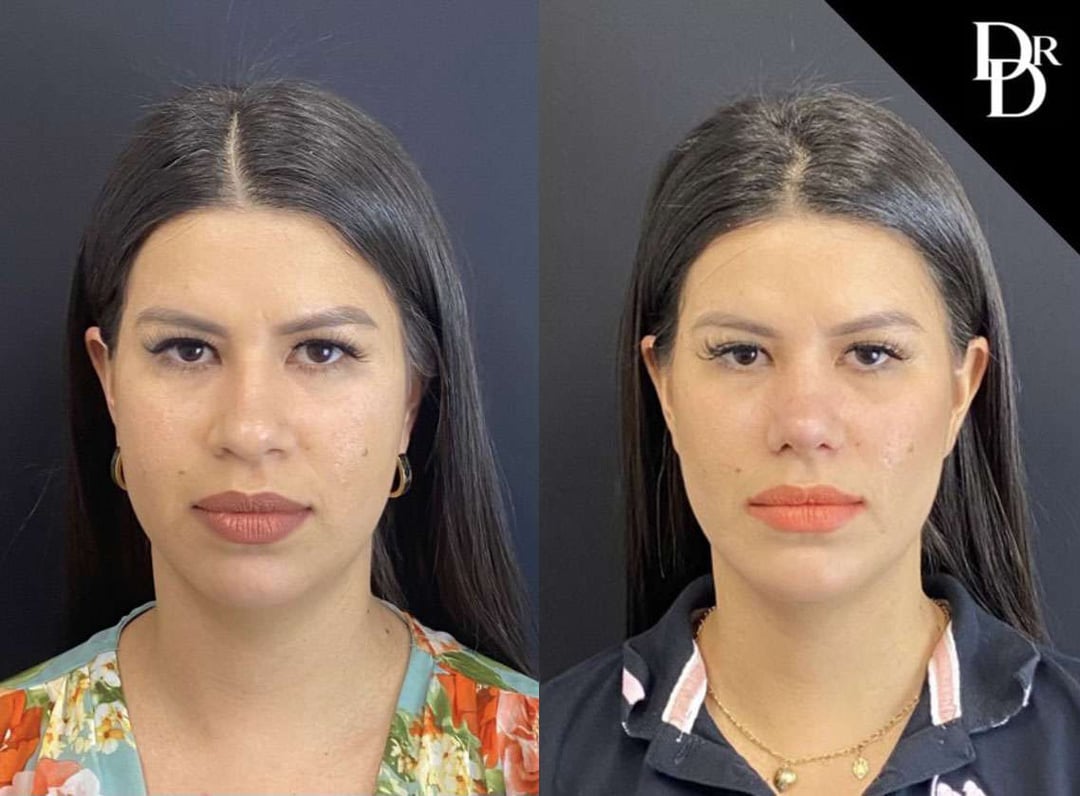 Rhinoplasty Before And After Photos By Dr. Demetri Arnaoutakis In Tampa, Fl