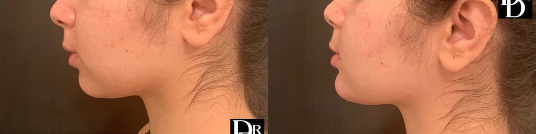 Chin Augmentation Before And After Photos By Dr. Demetri Arnaoutakis In Tampa, Fl