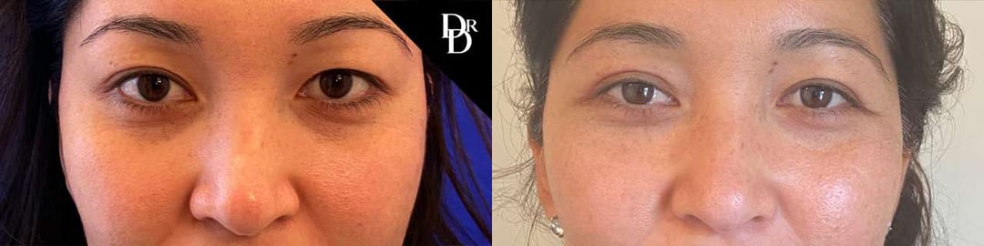 Eyelid Surgery Before And After Photos By Dr. Demetri Arnaoutakis In Tampa, Fl