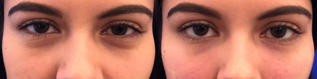 Injectable/Dermal Fillers Before And After Photos By Dr. Demetri Arnaoutakis In Tampa, Fl