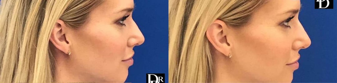 Liquid Rhinoplasty Before And After Photos By Dr. Demetri Arnaoutakis In Tampa, Fl