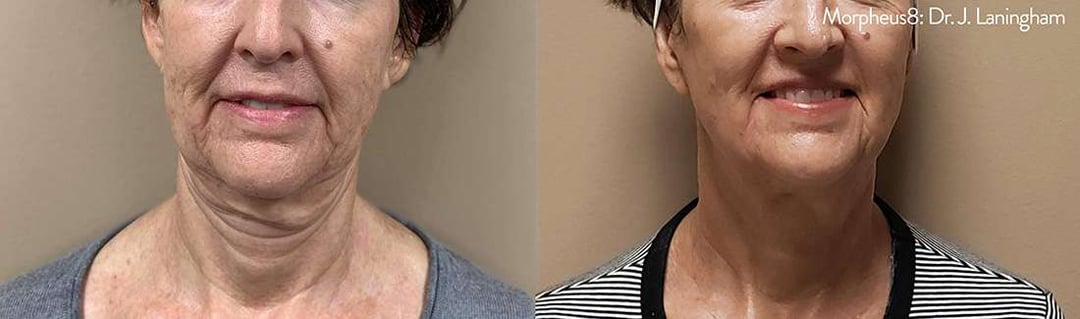 Morpheus8 Before And After Photos By Dr. Demetri Arnaoutakis In Tampa, Fl