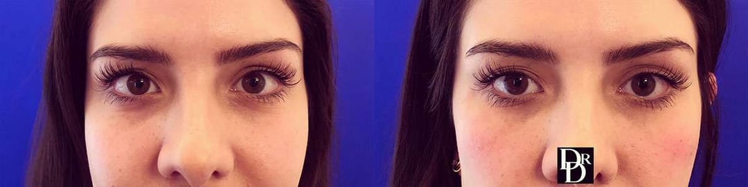 Injectable/Dermal Fillers Before And After Photos By Dr. Demetri Arnaoutakis In Tampa, Fl