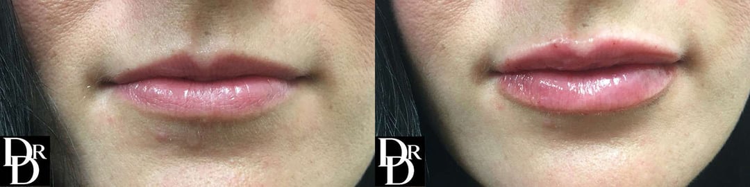 Injectable/Dermal Fillers Before And After Photos By Dr. Demetri Arnaoutakis In Tampa, Fl