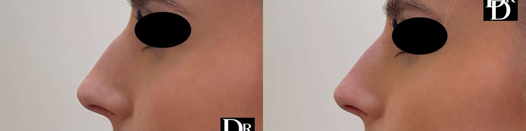 Liquid Rhinoplasty Before And After Photos By Dr. Demetri Arnaoutakis In Tampa, Fl