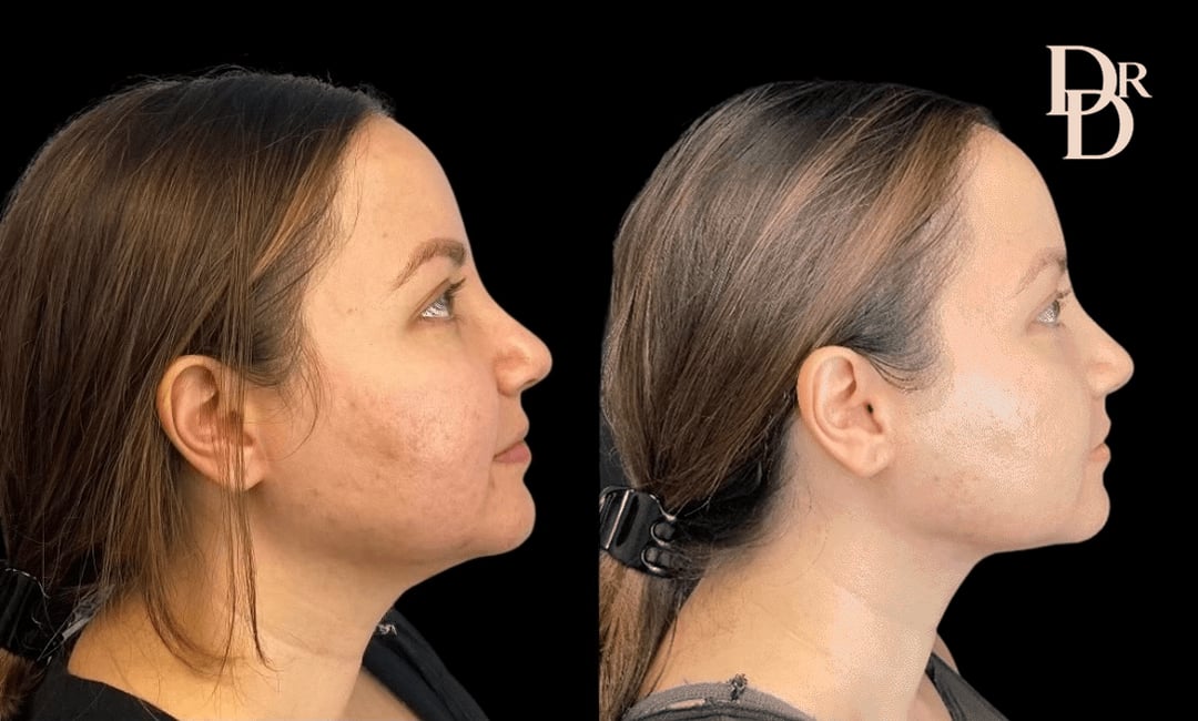 Morpheus8 Before And After Photos By Dr. Demetri Arnaoutakis In Tampa, Fl