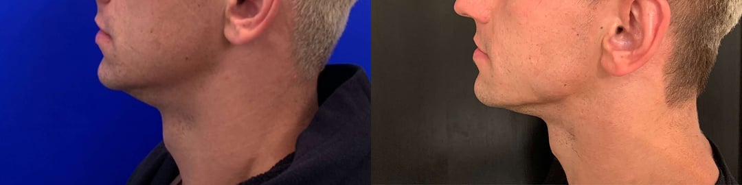 Neck Lift Before And After Photos By Dr. Demetri Arnaoutakis In Tampa, Fl