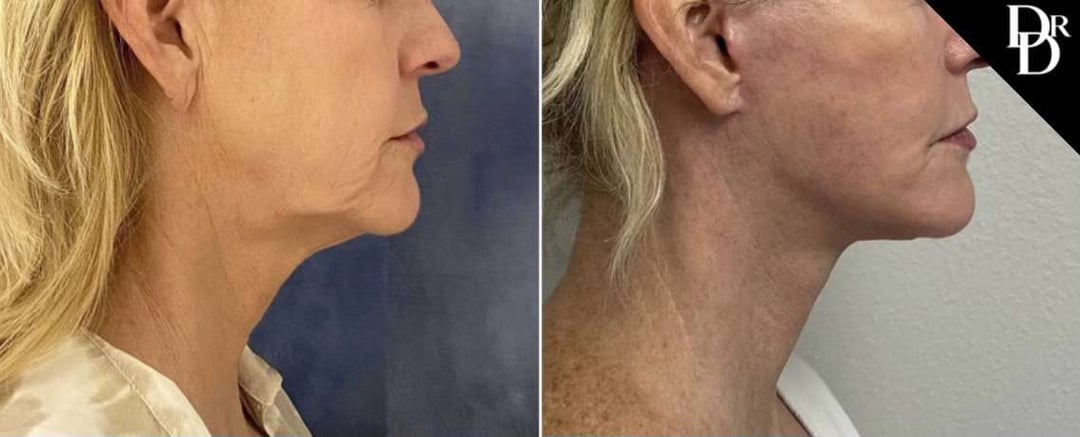 Facelift Before And After Photos By Dr. Demetri Arnaoutakis In Tampa, Fl