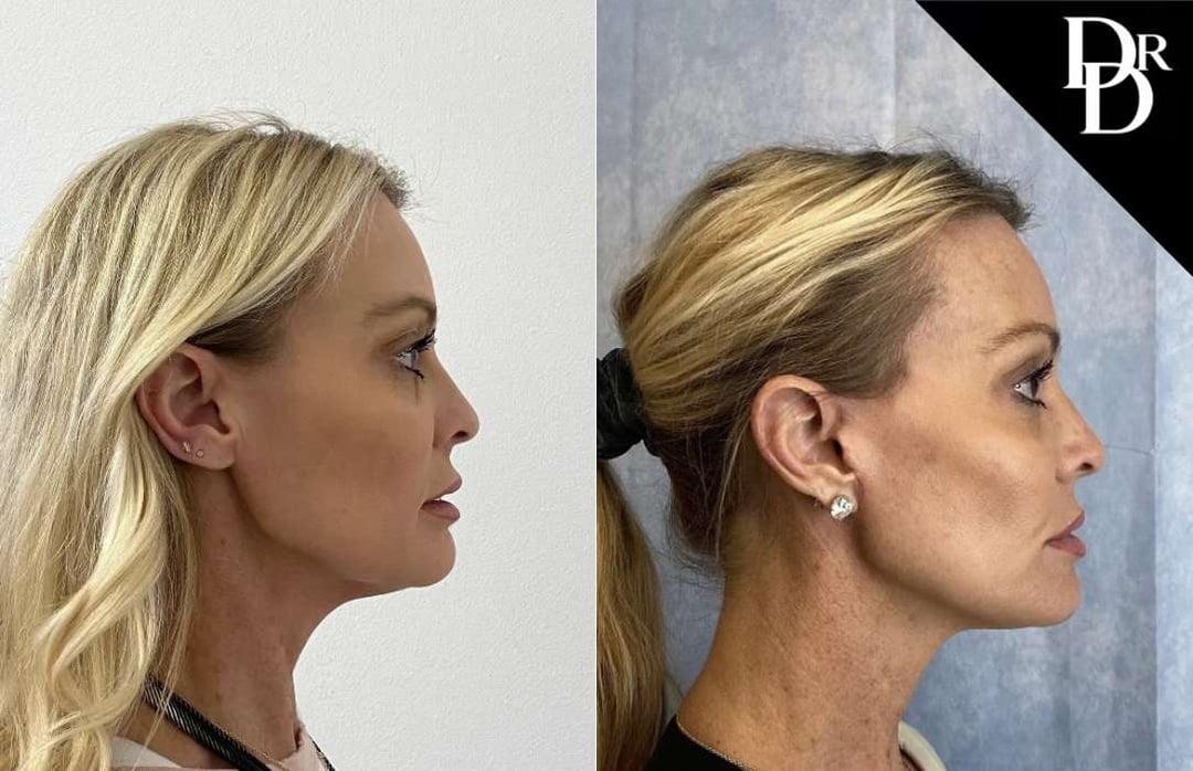 Facelift Before And After Photos By Dr. Demetri Arnaoutakis In Tampa, Fl