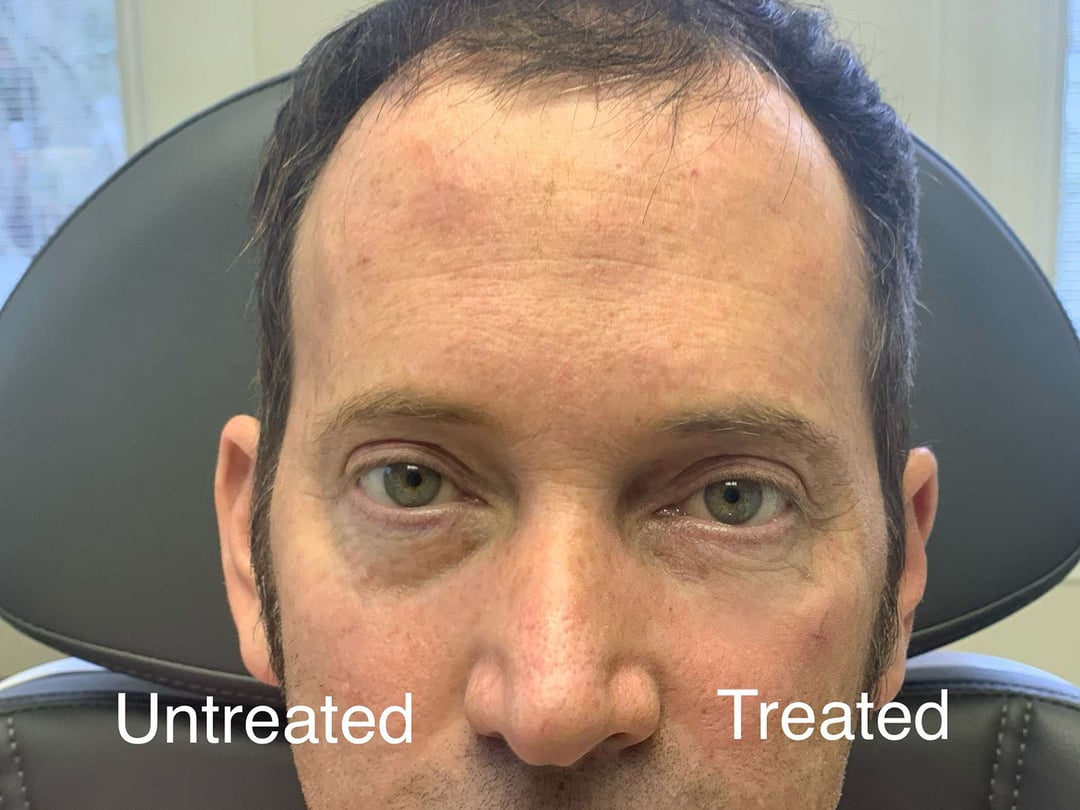 Injectable/Dermal Fillers Before And After Photos By Dr. Demetri Arnaoutakis In Tampa, Fl
