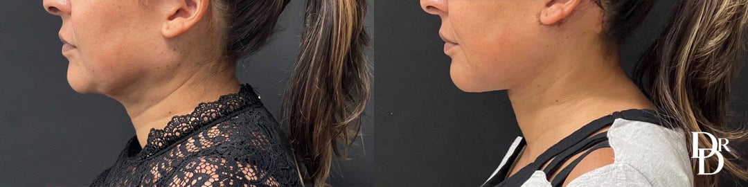 Neck Lift Before And After Photos By Dr. Demetri Arnaoutakis In Tampa, Fl
