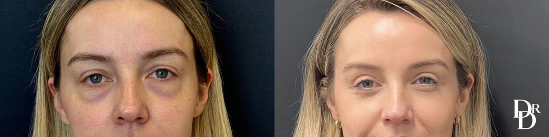 Upper &Amp; Lower Blepharoplasty Before And After Photos By Dr. Demetri Arnaoutakis In Tampa, Fl