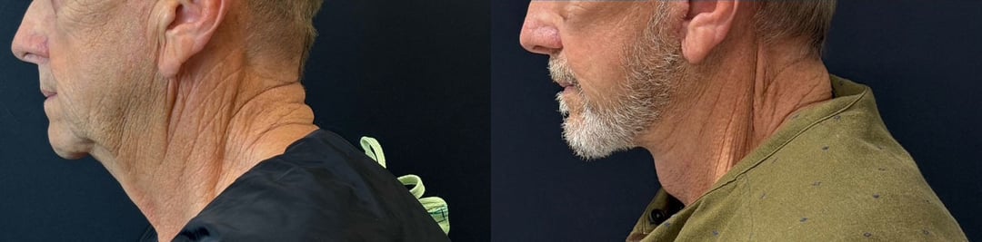 Face And Neck Lift Before And After Photo By Dr. Demetri In Beverly Hills California