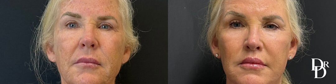 Lip Lift Before And After Photos By Dr. Demetri Arnaoutakis In Tampa, Fl