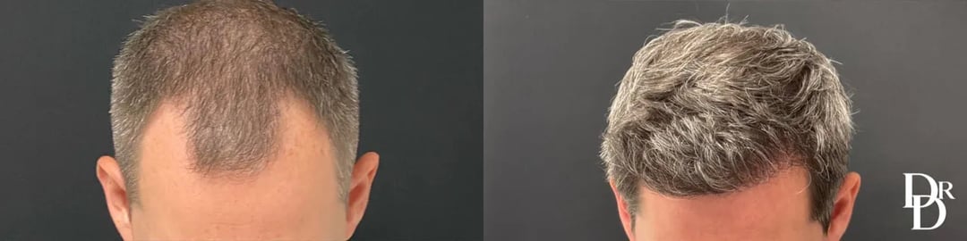 Hair Transplant Before And After Photos By Dr. Demetri Arnaoutakis In Tampa, Fl
