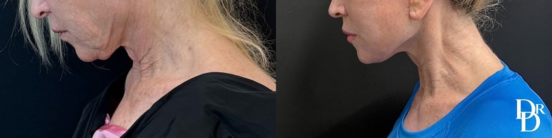 Neck Lift Before And After Photos By Dr. Demetri Arnaoutakis In Tampa, Fl