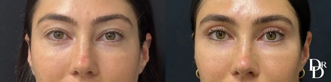 Upper Blepharoplasty Before And After Photos By Dr. Demetri Arnaoutakis In Tampa, Fl